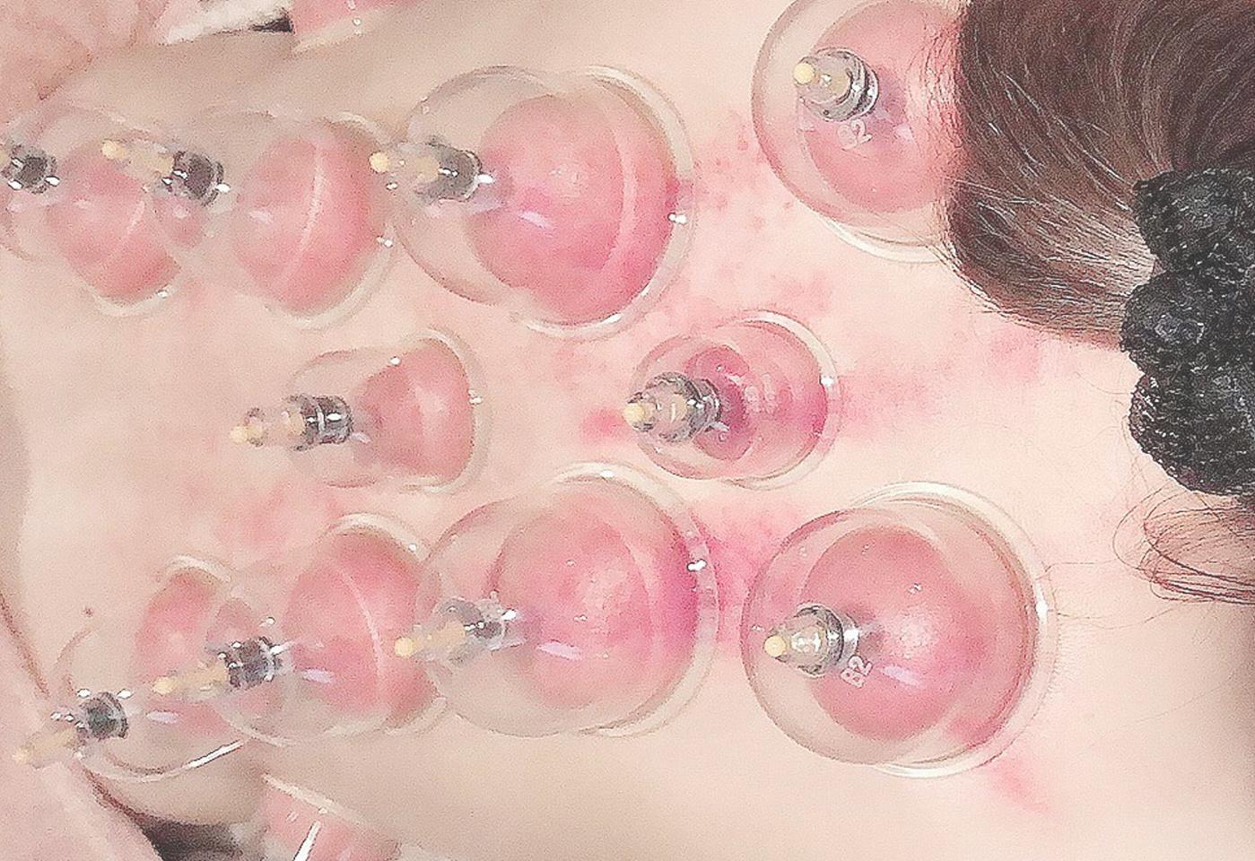 カッサ・カッピング画像